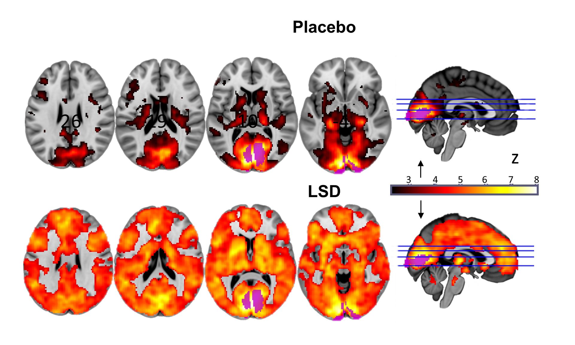 Brain scans comparing activity under placebo and LSD, highlighting significant differences in neural activation patterns.