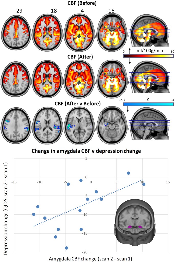 Brain scans showing CBF changes before and after treatment, with a scatter plot correlating amygdala CBF and depression ch...