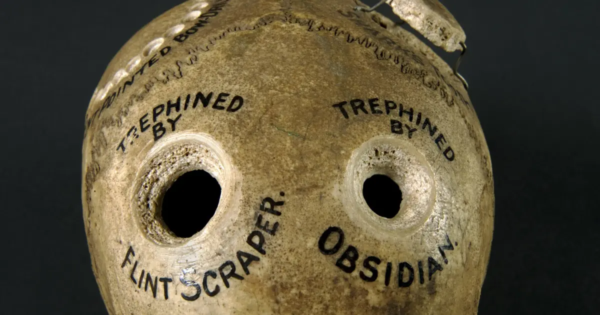 Trepanation: A Brief History of Drilling Holes in the Head ...