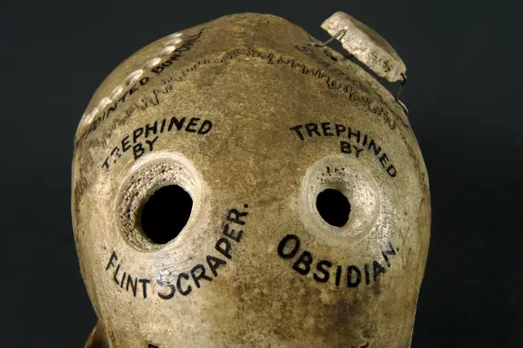 Ceramic vessel with two holes, labeled "Trephined by Flint Scraper" and "Trephined by Obsidian," on a dark background.