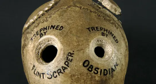 Ceramic vessel with two holes, labeled "Trephined by Flint Scraper" and "Trephined by Obsidian," on a dark background.