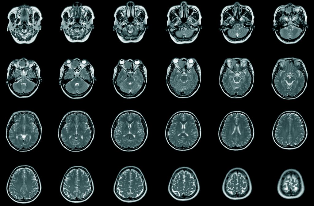 Series of MRI scans showing various cross-sections of the human brain, highlighting different anatomical structures.