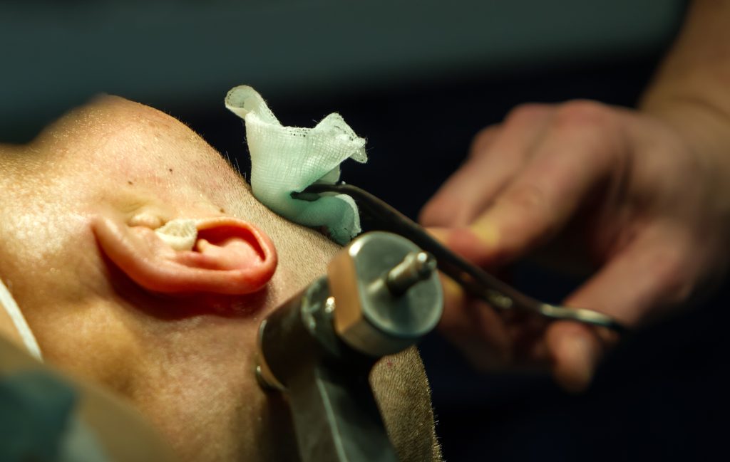 Surgical procedure in progress, with a hand holding scissors near a patient's ear and a gauze pad on the skin.