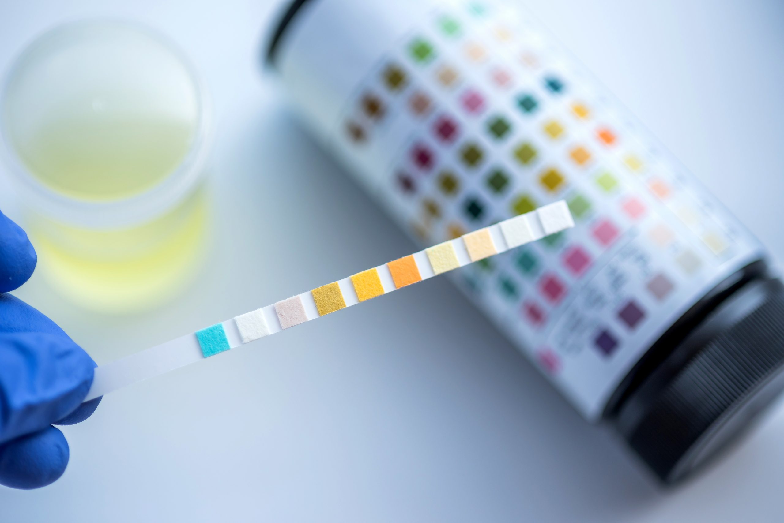 Urine test strip held by a gloved hand, with a color chart and sample in the background.